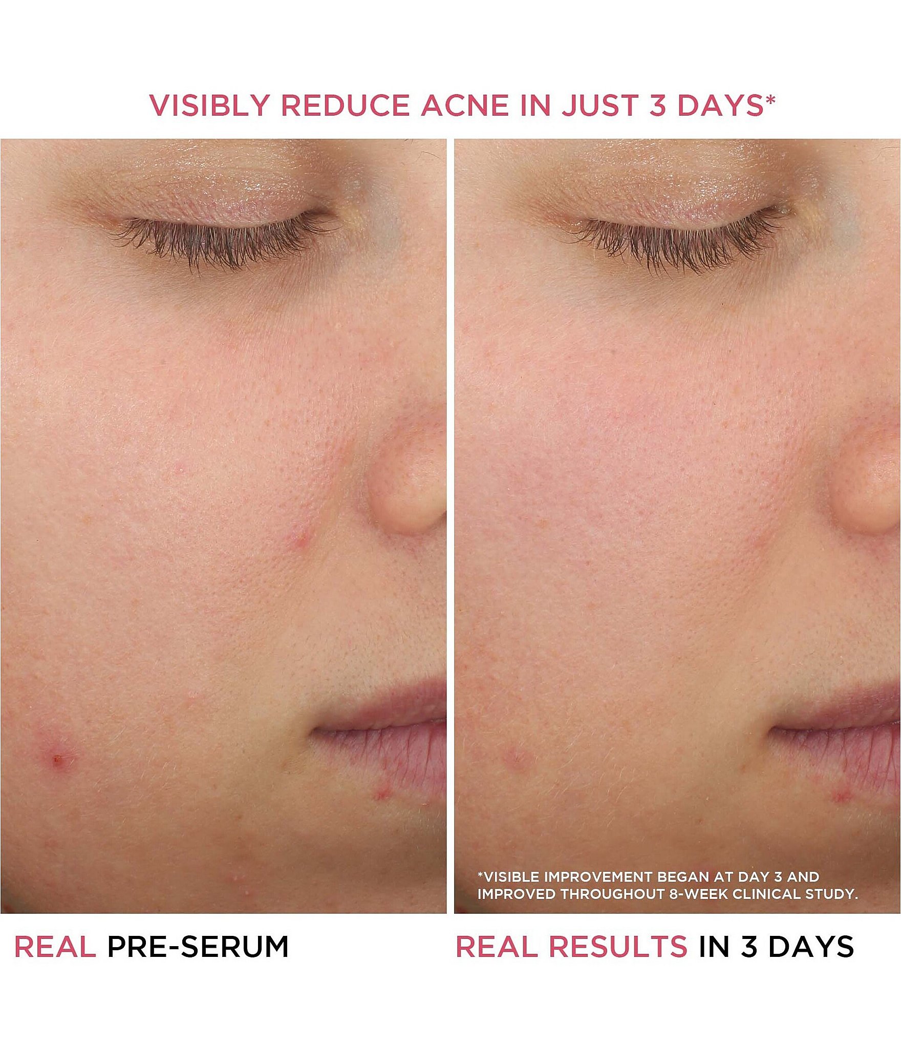 IT Cosmetics Bye Bye Breakout Salicylic Acid Acne Serum